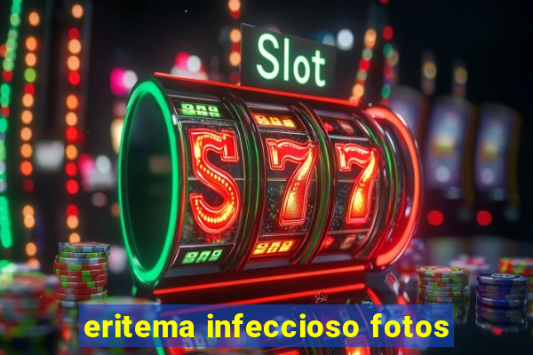 eritema infeccioso fotos